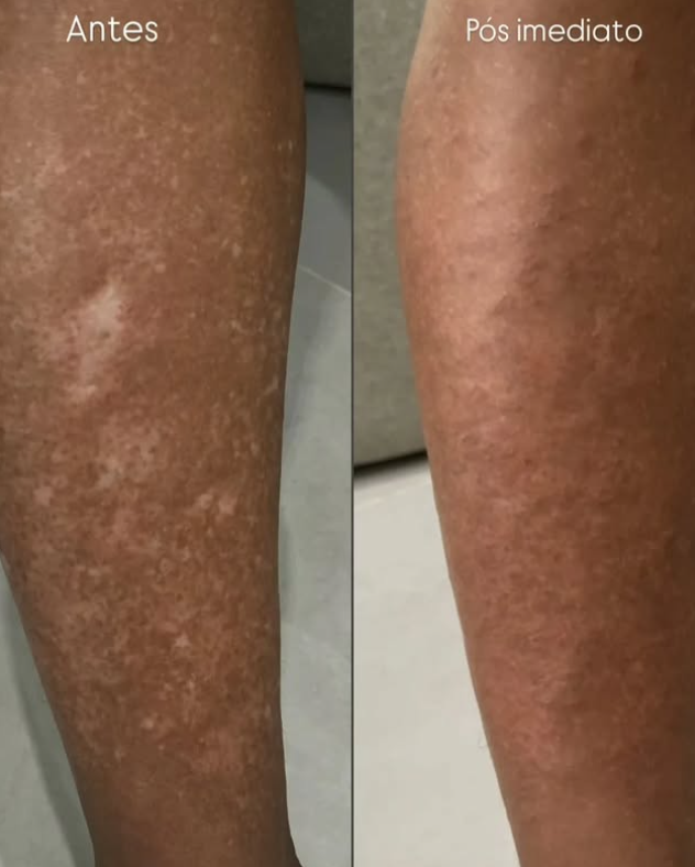 Resultado de camuflagem estética